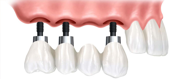 birden-fazla-dis-eksikliginde-implant-tedavisi