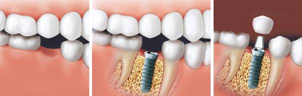 implant-tedavisi-nedir 