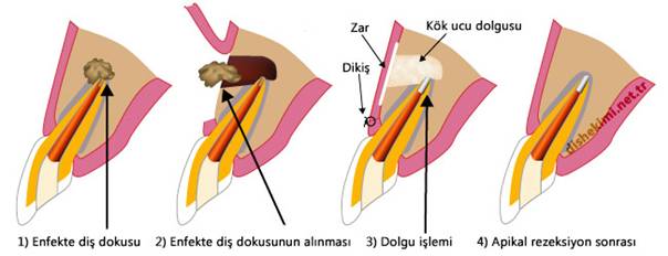 http://www.dtharunyildirim.com/images/home/apikal-rezeksiyon.jpg