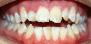 http://petalumabraces.com/wp-content/uploads/2009/11/open-bite.jpg