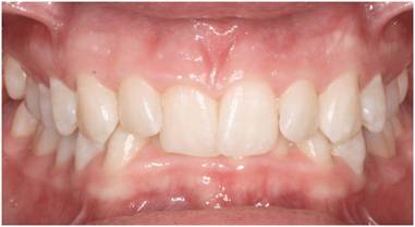 http://www.barberorthodontics.com.au/images/deepbite-2.jpg