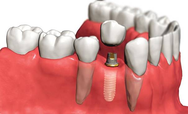 tek-dis-eksikliginde-implant-tedavisi